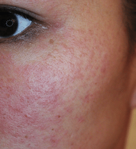geluid Tenslotte vloeiend Gevoelige en/of allergische huid? - Schoonheidssalon Suzanne Hoofddorp